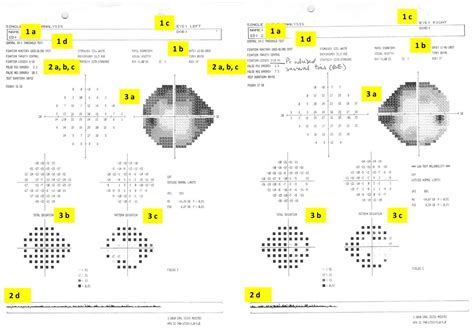 automated perimetry test results interpretation|How to interpret visual fields .